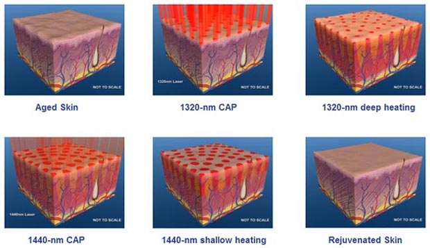 Laser de rajeunissement