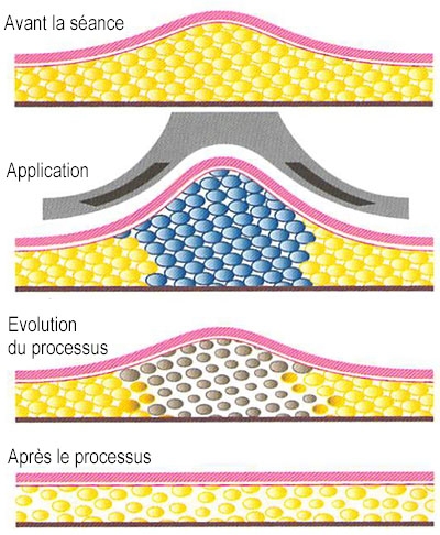 Processu de cryolipolyse