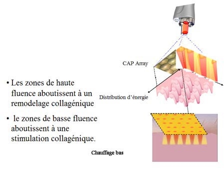 Rajeunissement au laser Affirm