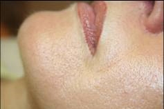 Rajeunissement des contours de la bouche au laser