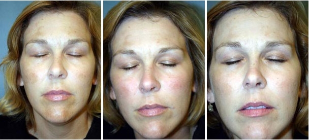 Traitement du Melasma au laser