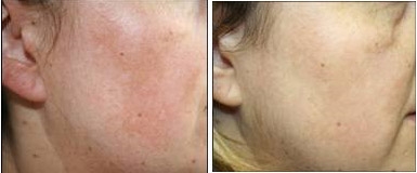 Traitement du Melasma au laser